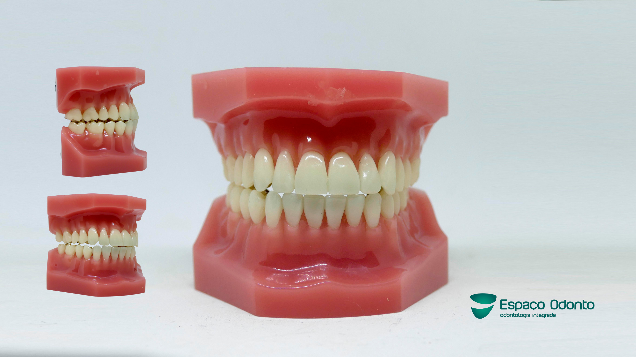 Dentes desalinhados podendo afetar mastigação e saúde bucal