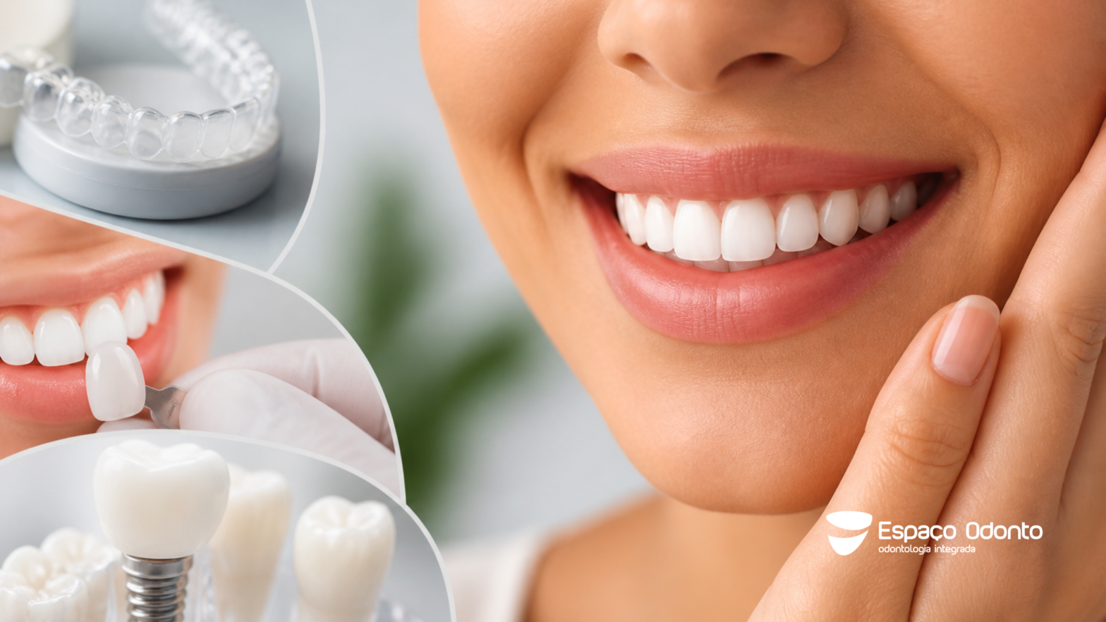 Estética do sorriso com combinação de tratamentos odontológicos para resultados naturais