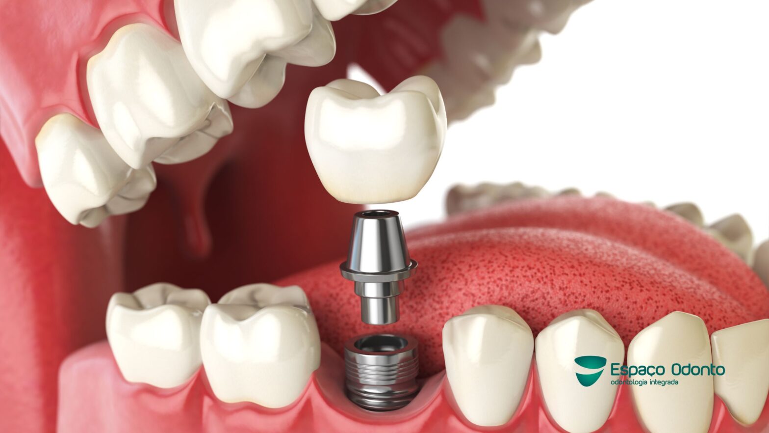Paciente em avaliação por dificuldade para mastigar e indicação de prótese dentária